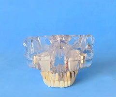 Dental Sinuses Implants Bridge Veneers Models All On Four 30 Degree Angle Screws