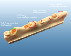 tooth gum impaction eruption  extraction model block