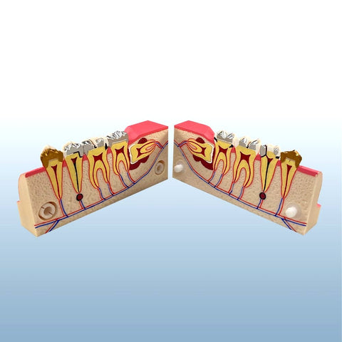 Endodontic Teeth Disease Pathology Model 