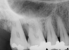 Adult Dental Intraoral X-Ray Practice Simulator 32 Radiopaque Teeth - Manikin Phantom Head & Floor Mount Complete