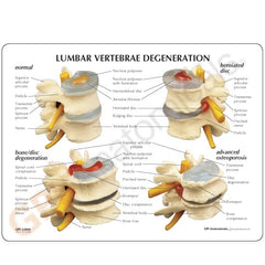 spine disk degeneration 4 stage model