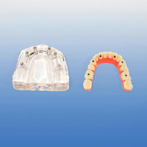 six implants overdenture model