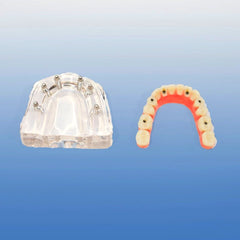 six implants overdenture model