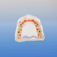 dental overdanture model six implants