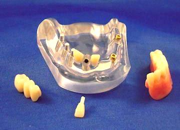 6 Implants Combo Denture 4 Parts Restoration Model