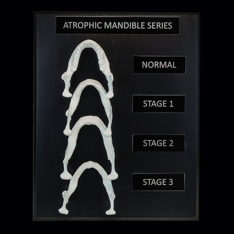 atrophic mandible models series