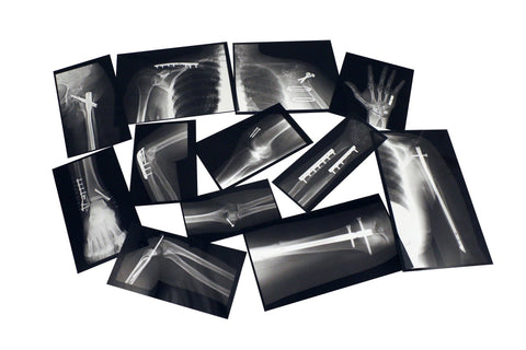 fixed bones x-ray images