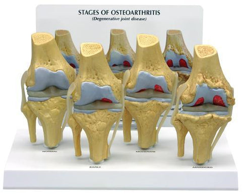 Knee Degeneration 4 Stage Osteoarthritis