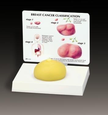 Breast Cancer Model With 3 Lumps Model