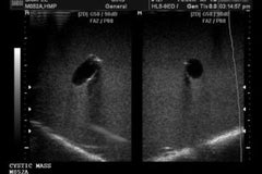 Breast Ultrasound Guided Needle Biopsy Simulator Phantom Model With Amorphous Leasions