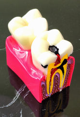 Teeth Caries Gum Disease Model With Bone Loss Dental Oral Pathologies