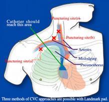 Central Venous Cannulation Ultrasound Guided CVC Simulator