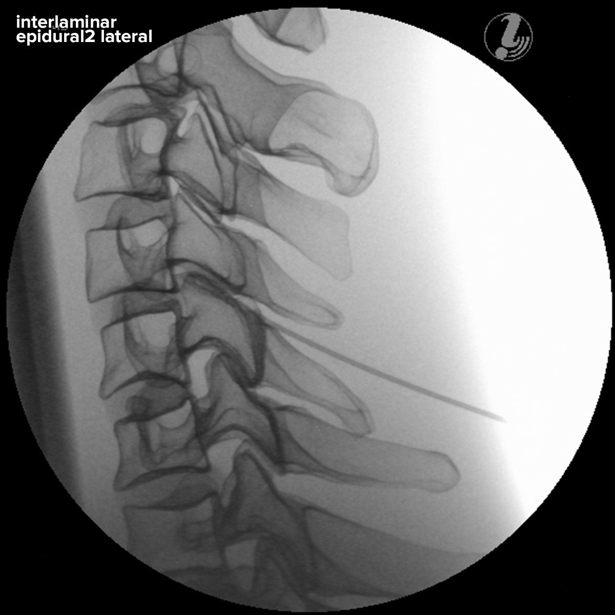 Spine Model Injection Cervical Spine Injection Model: Image Guided – Buyamag INC