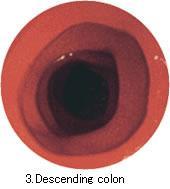 Replacement Semi-Difficult Intestine