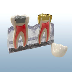 endodontic cracked tooth crown model