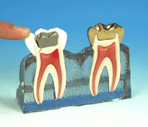 cracked tooth model