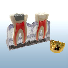 cracked tooth syndrome crown model