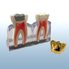 cracked tooth syndrome model