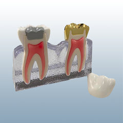 endodontic cracked tooth syndrome model