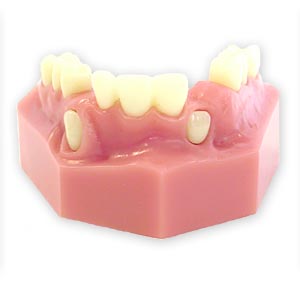 Cuspid Exposure Lateral Incisor Orthodontic Model