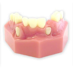 Cuspid Exposure Lateral Incisor Orthodontic Model