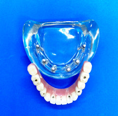 6 Implants High Water Bridge Dental Model