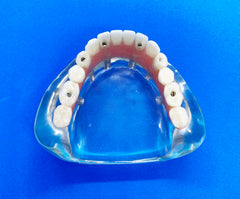 6 Implants High Water Bridge Dental Model