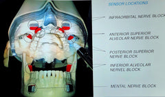 Dental sedation Anesthesia Oral Injection simulator