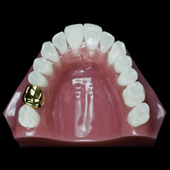 dental gold crown bridge model