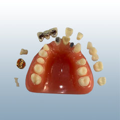 dental cosmetic inlay restoration model