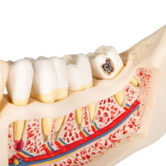 dental disease teaching model