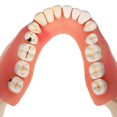 periodontal teeth caries model