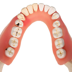 Dental Disease Educaton Model 2 Times Periodontis Caries Inflamation Life-Size 21 Parts