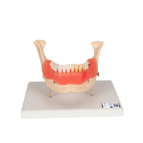 dental disease model