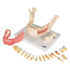 dental pathology model