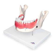 dental disease model