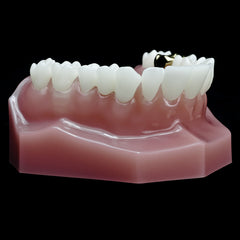 dental restoration model