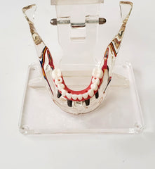 sinus lift restoration implants bridge model 