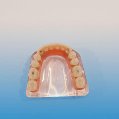 Dental Mandible Implant Model 4 Implants screws