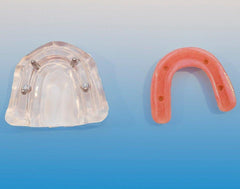 Dental Implant Model 4 Implants Screws Over-denture