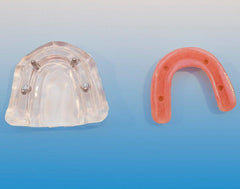 Dental Implant Model 4 Implants Screws Over-denture