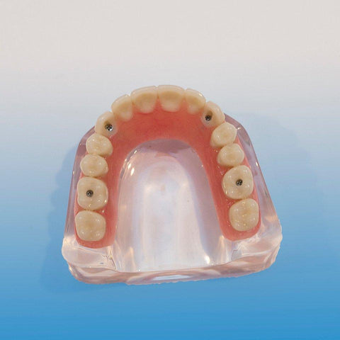 Dental Maxillary Implant Model 4 Implants Simulated Screws Over-denture