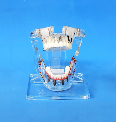 sinus lift implants bridges model