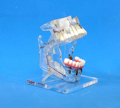 cosmetic implant model with sinus lift