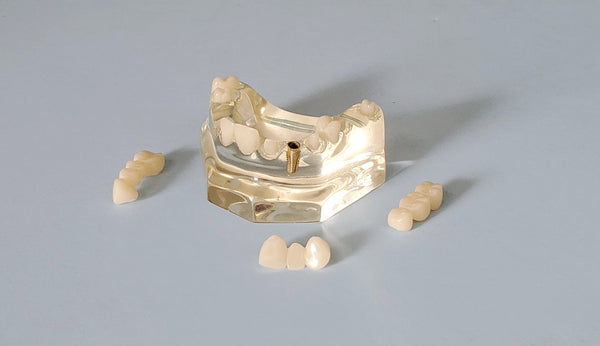 Dental Patient Education Presentation Model 3 Bridges 1 Crown