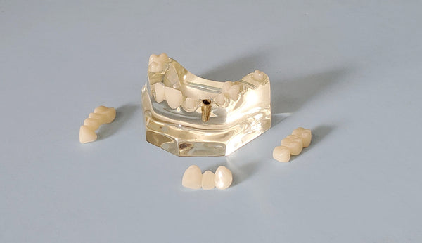 Bridge Tooth Cap Model Dental Patient Model- Bridge Implant Crown – Buyamag INC