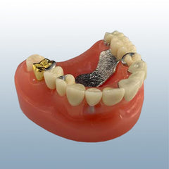 dental bridge restoration model