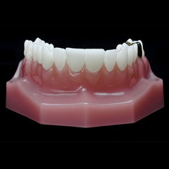 dental veneer restoration model