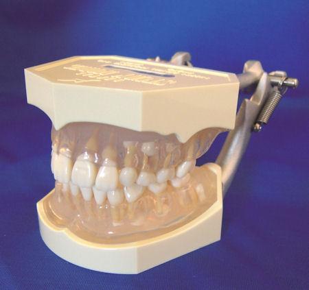 Anatomically Shaped Gingivae Model Mixed Dentition Removable Teeth