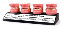 child dental tooth decay models